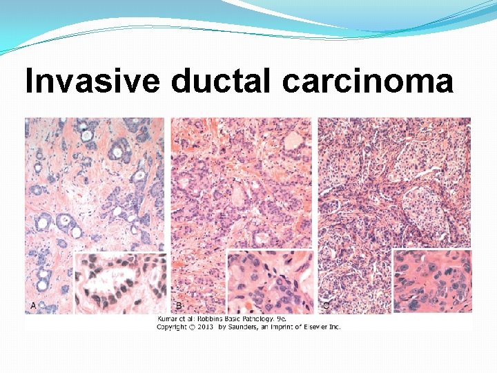 Invasive ductal carcinoma 