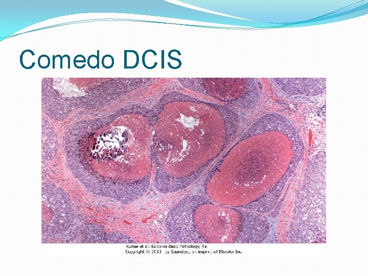 Comedo DCIS 