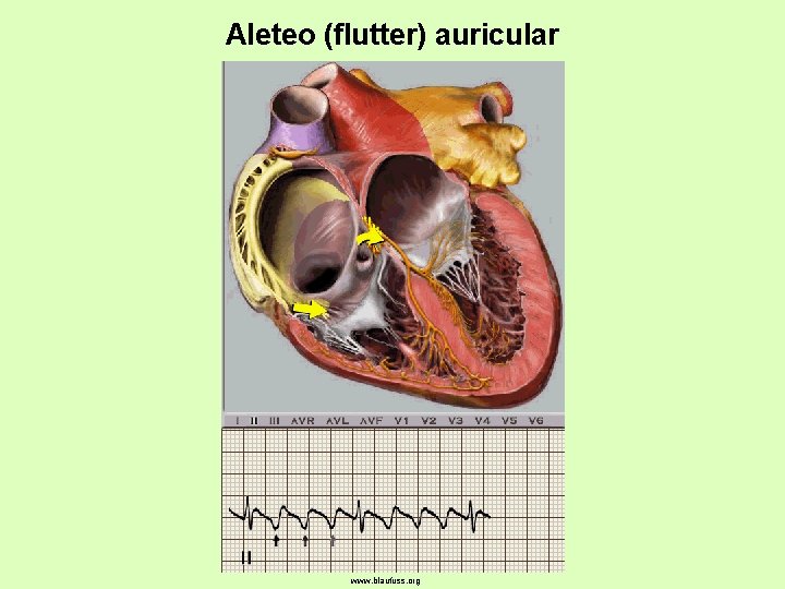 Aleteo (flutter) auricular www. blaufuss. org 