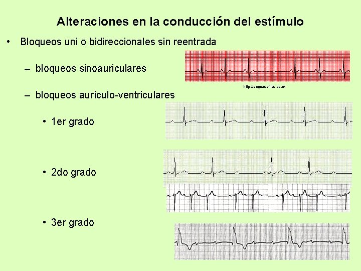 Alteraciones en la conducción del estímulo • Bloqueos uni o bidireccionales sin reentrada –