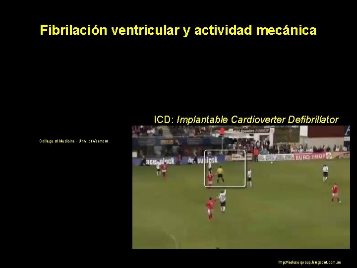 Fibrilación ventricular y actividad mecánica ICD: Implantable Cardioverter Defibrillator Colllege of Medicine - Univ.