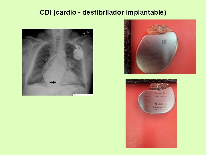 CDI (cardio - desfibrilador implantable) 