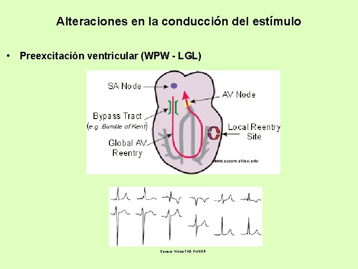 Alteraciones en la conducción del estímulo • Preexcitación ventricular (WPW - LGL) www. oucom.