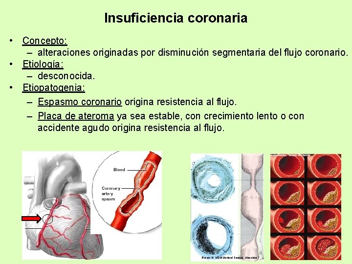 Insuficiencia coronaria • Concepto: – alteraciones originadas por disminución segmentaria del flujo coronario. •