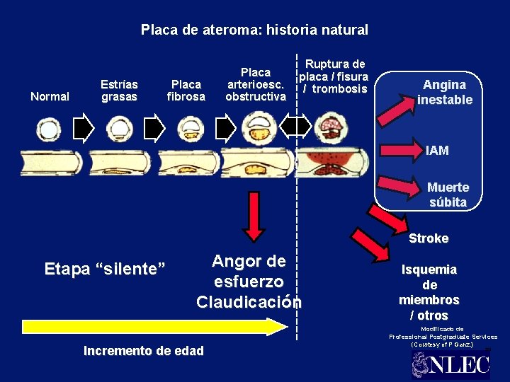 Placa de ateroma: historia natural Normal Estrías grasas Placa fibrosa Placa arterioesc. obstructiva Ruptura