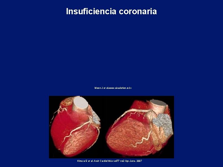 Insuficiencia coronaria Moon J et al. www. circulation. or. kr Kimura E et al.