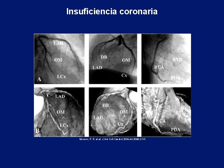 Insuficiencia coronaria Moreno, P. R. et al. J Am Coll Cardiol 2004; 44: 2099