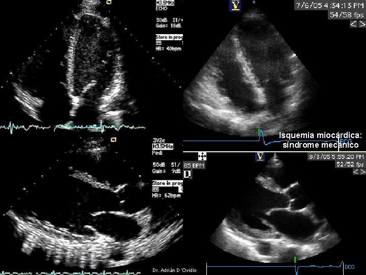 Isquemia miocárdica: síndrome mecánico Dr. Adrián D´Ovidio 