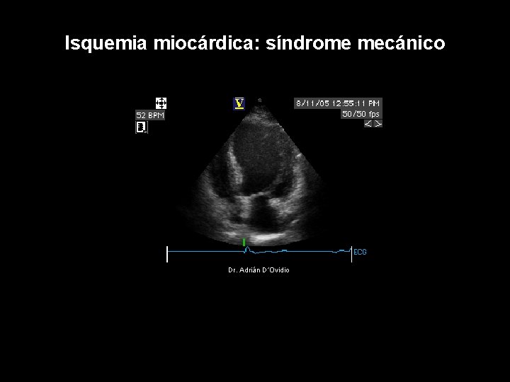 Isquemia miocárdica: síndrome mecánico Dr. Adrián D´Ovidio 