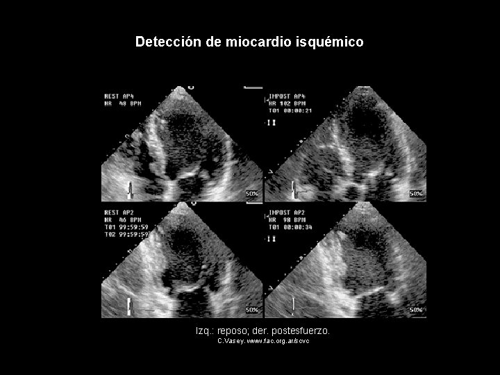 Detección de miocardio isquémico Izq. : reposo; der. postesfuerzo. C. Vasey. www. fac. org.