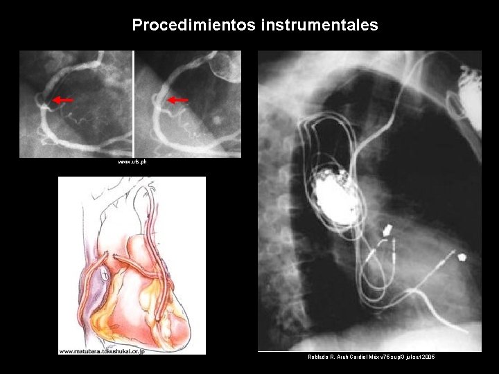 Procedimientos instrumentales www. ufs. ph Robledo R. Arch Cardiol Méx v 75 supl 3