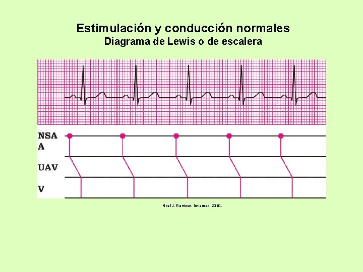 Estimulación y conducción normales Diagrama de Lewis o de escalera Noel J. Ramírez. Intramed.