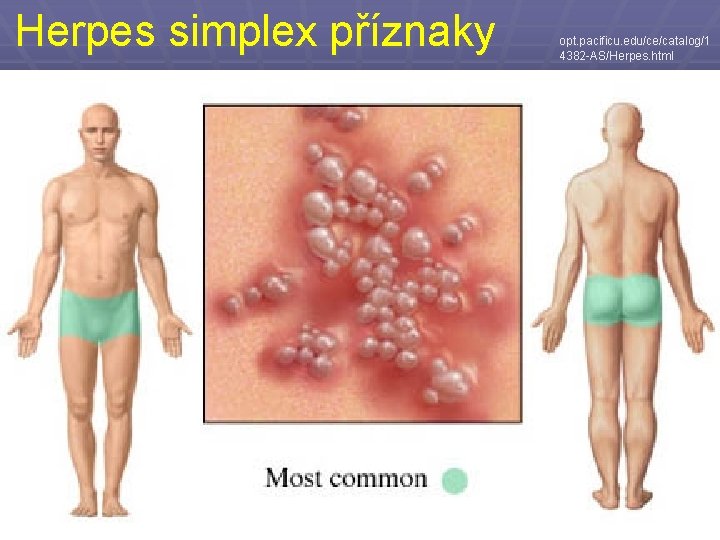 Herpes simplex příznaky opt. pacificu. edu/ce/catalog/1 4382 -AS/Herpes. html 