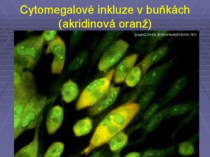 Cytomegalové inkluze v buňkách (akridinová oranž) pages 2. inrete. it/mbiomed/photomic. htm 