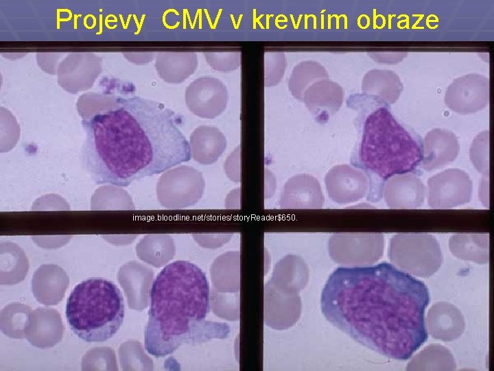 Projevy CMV v krevním obraze image. bloodline. net/stories/story. Reader$650. 