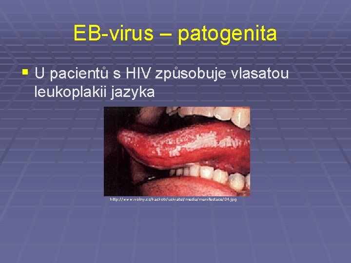 EB-virus – patogenita § U pacientů s HIV způsobuje vlasatou leukoplakii jazyka http: //www.