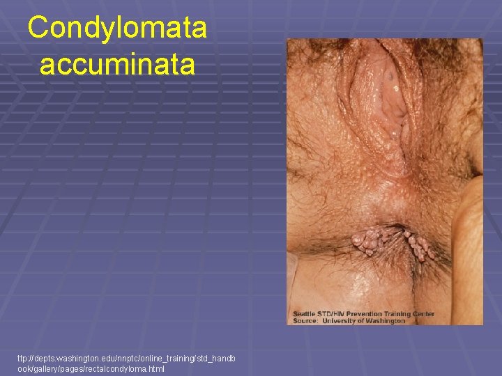 Condylomata accuminata ttp: //depts. washington. edu/nnptc/online_training/std_handb ook/gallery/pages/rectalcondyloma. html 