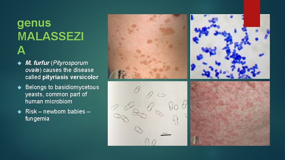 genus MALASSEZI A M. furfur (Pityrosporum ovale) causes the disease called pityriasis versicolor Belongs