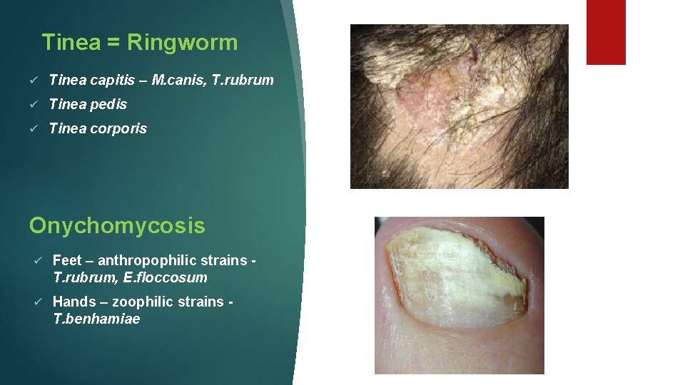 Tinea = Ringworm ü Tinea capitis – M. canis, T. rubrum ü Tinea pedis