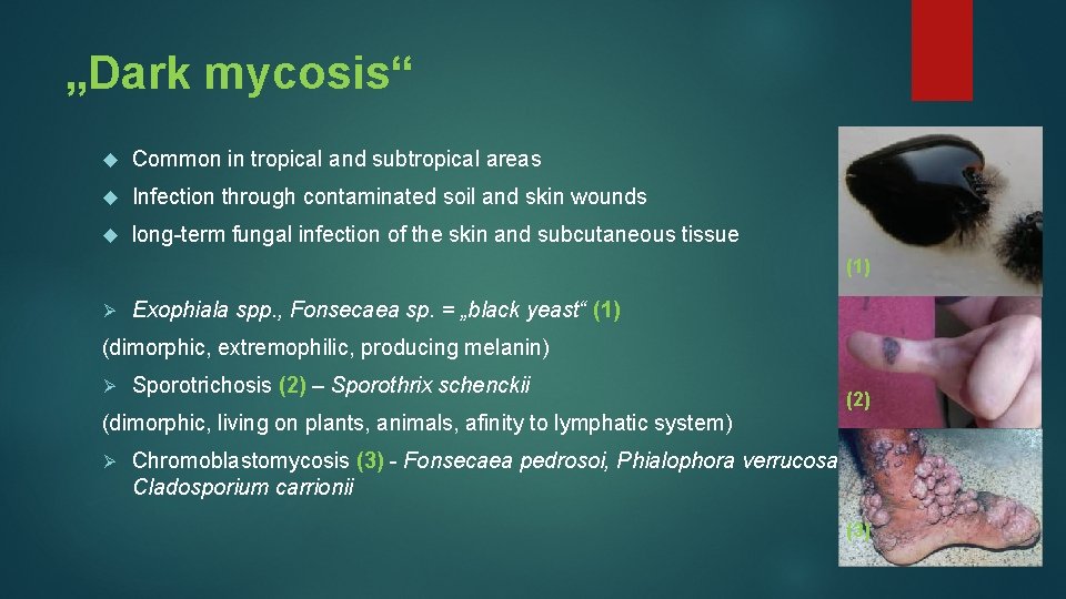 „Dark mycosis“ Common in tropical and subtropical areas Infection through contaminated soil and skin