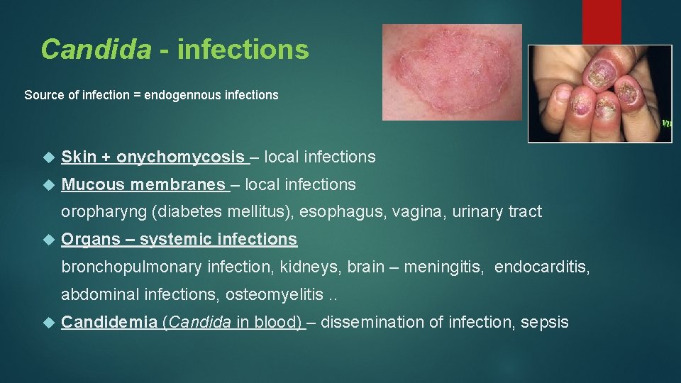 Candida - infections Source of infection = endogennous infections Skin + onychomycosis – local