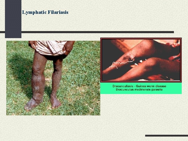 Lymphatic Filariasis 