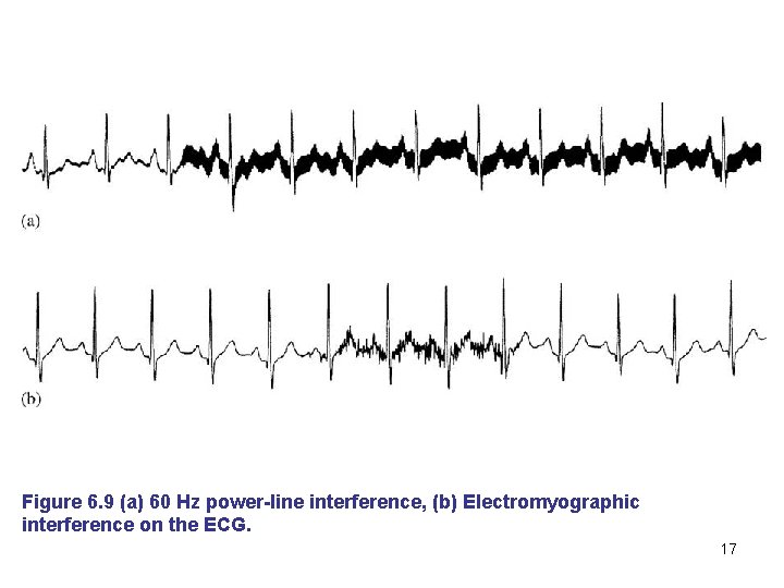 Figure 6. 9 (a) 60 Hz power-line interference, (b) Electromyographic interference on the ECG.