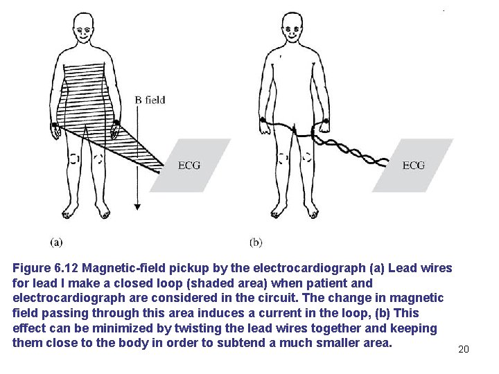 Figure 6. 12 Magnetic-field pickup by the electrocardiograph (a) Lead wires for lead I