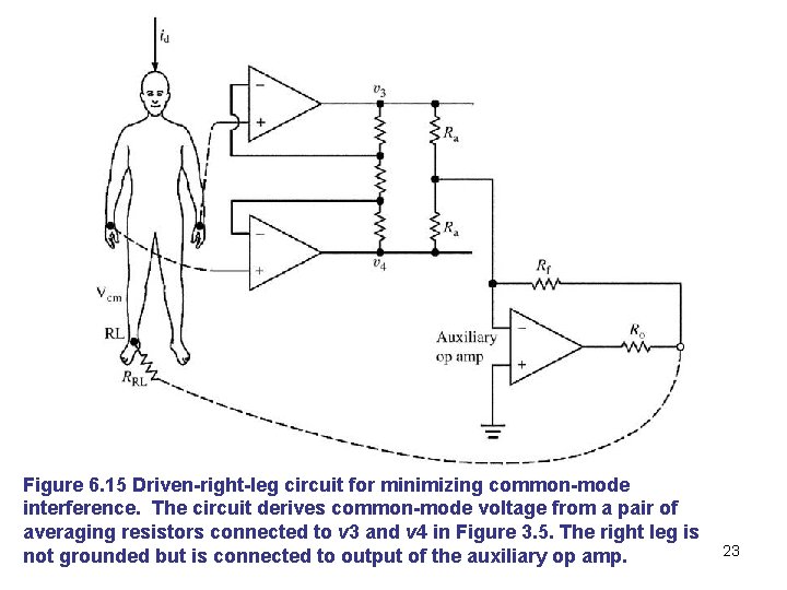 Figure 6. 15 Driven-right-leg circuit for minimizing common-mode interference. The circuit derives common-mode voltage
