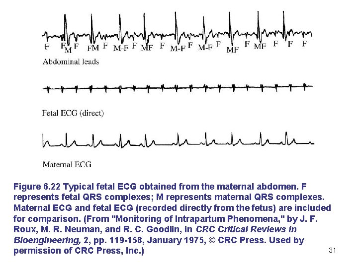 Figure 6. 22 Typical fetal ECG obtained from the maternal abdomen. F represents fetal