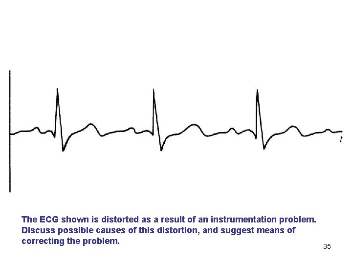 The ECG shown is distorted as a result of an instrumentation problem. Discuss possible