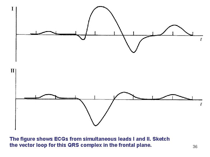 The figure shows ECGs from simultaneous leads I and II. Sketch the vector loop