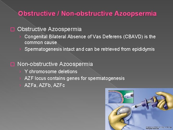 Obstructive / Non-obstructive Azoopsermia � Obstructive Azoospermia › Congenital Bilateral Absence of Vas Deferens