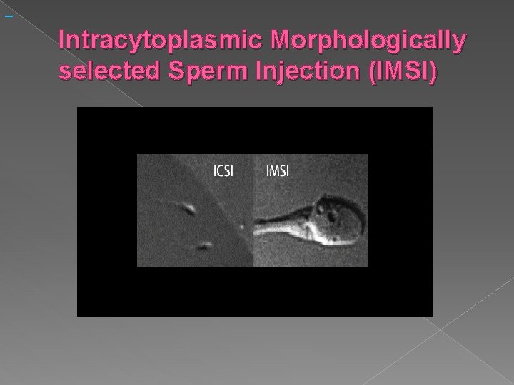 Intracytoplasmic Morphologically selected Sperm Injection (IMSI) 