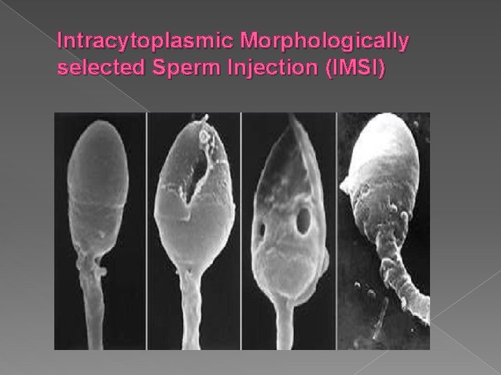 Intracytoplasmic Morphologically selected Sperm Injection (IMSI) Type: JPG 