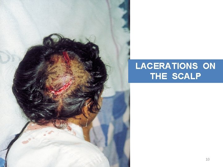 LACERATIONS ON THE SCALP 10 