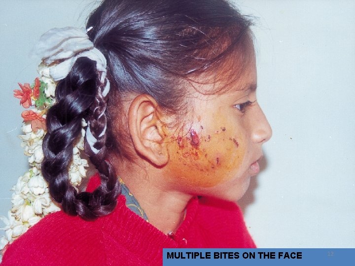 MULTIPLE BITES ON THE FACE 12 