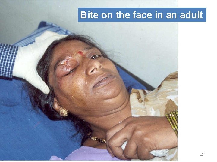 Bite on the face in an adult 13 