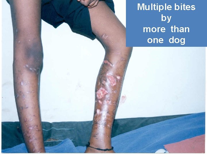 Multiple bites by more than one dog 14 