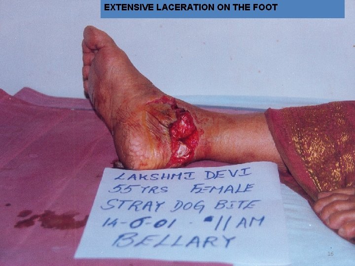 EXTENSIVE LACERATION ON THE FOOT 16 