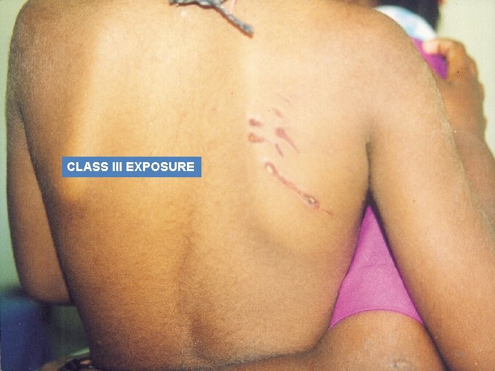 CLASS III EXPOSURE 19 