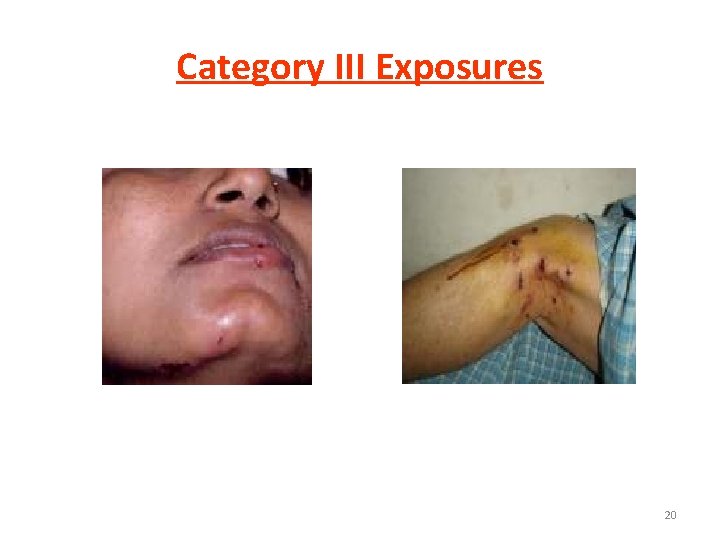 Category III Exposures 20 