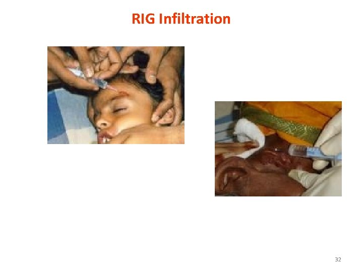 RIG Infiltration 32 