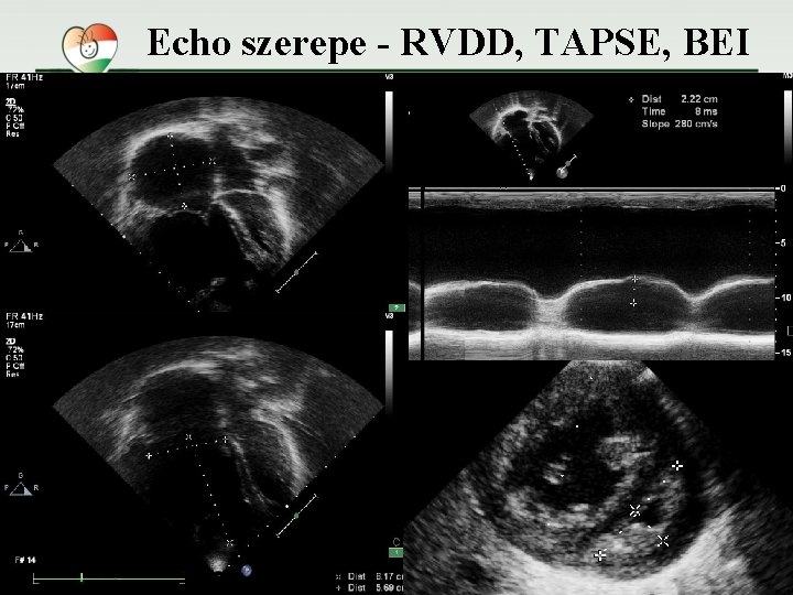 Echo szerepe - RVDD, TAPSE, BEI 