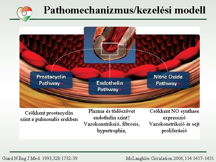 Pathomechanizmus/kezelési modell Csökkent prostacyclin szint a pulmonalis erekben Giaid N Eng J Med. 1993;