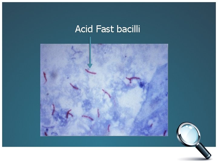 Acid Fast bacilli 