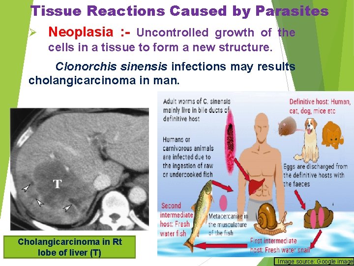 Tissue Reactions Caused by Parasites Ø Neoplasia : - Uncontrolled growth of the cells