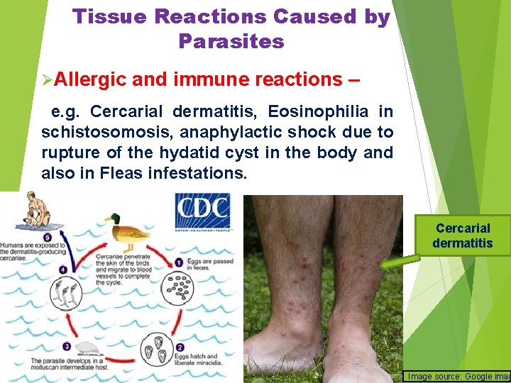Tissue Reactions Caused by Parasites ØAllergic and immune reactions – e. g. Cercarial dermatitis,