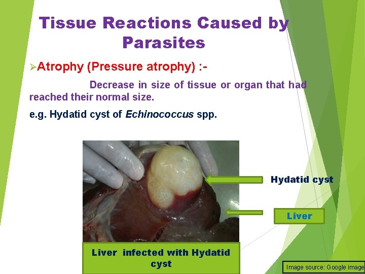 Tissue Reactions Caused by Parasites ØAtrophy (Pressure atrophy) : - Decrease in size of