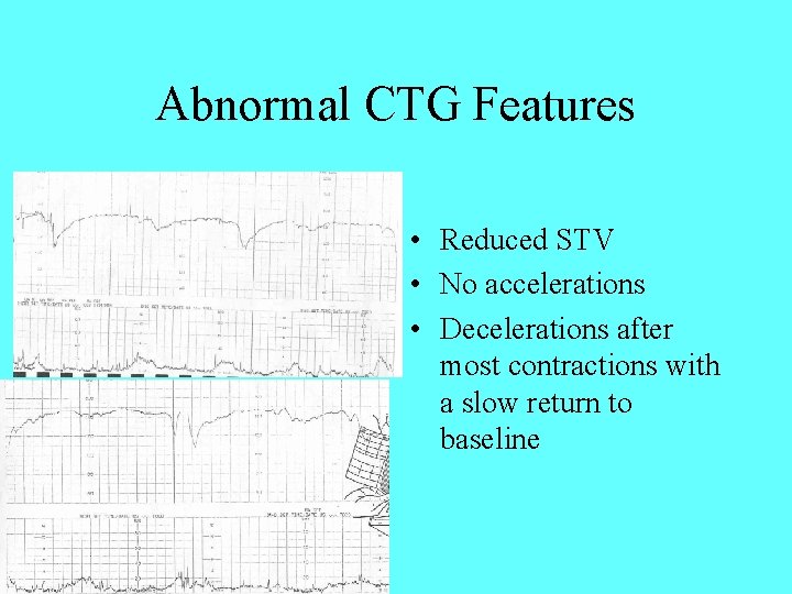 Abnormal CTG Features • Reduced STV • No accelerations • Decelerations after most contractions